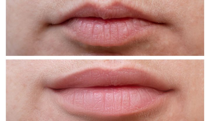Lip Flip Before and After