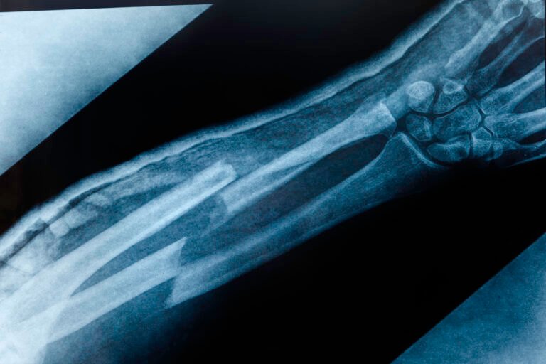What is the Broken Bone Theory