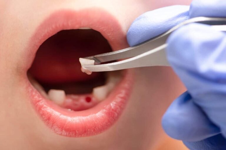 Kill Tooth Pain Nerve in 3 Seconds Permanently