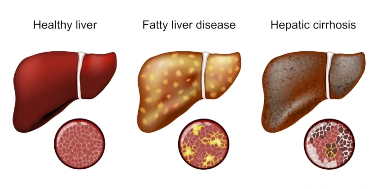 What Are the 4 Stages of Cirrhosis of the Liver